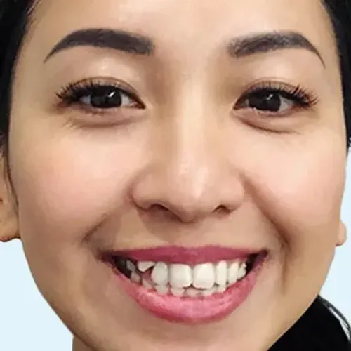 Sonrisa de mujer antes del tratamiento de ortodoncia