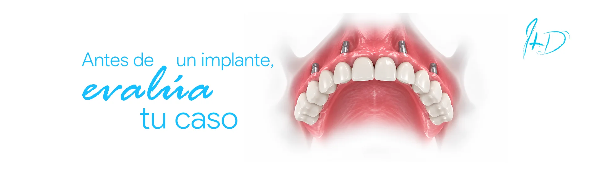 Antes de un implante, evaluá tu caso — Ivaskevich Design Odontología, Encarnación
